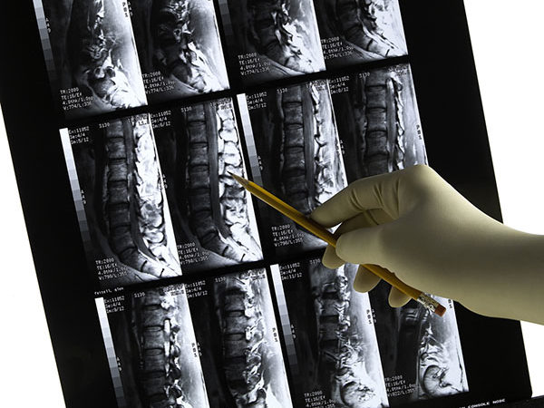 Minimally invasive spinal fusion