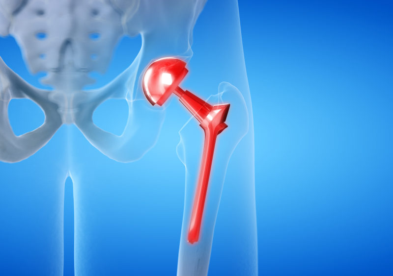 minimally invasive anterior hip replacement