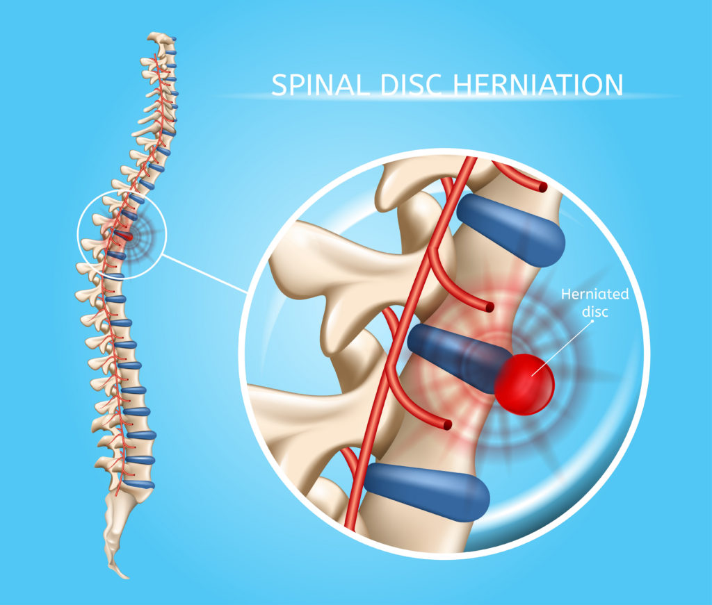 spine surgery herniated disc