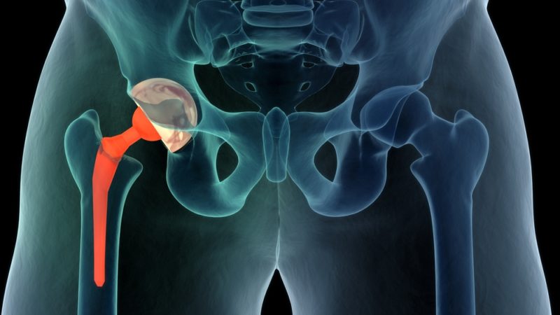 anterior total hip replacement
