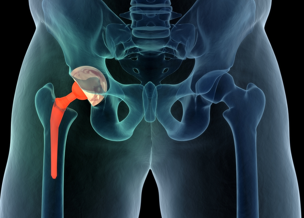 anterior total hip replacement