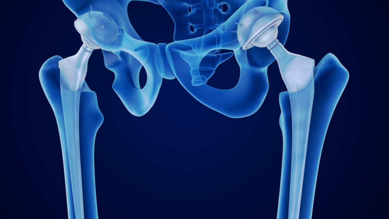 benefits of anterior hip replacement