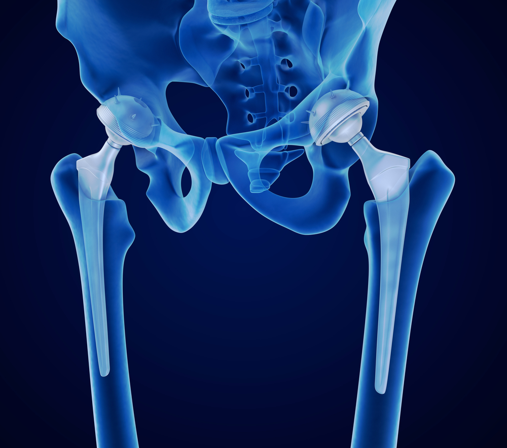 benefits of anterior hip replacement